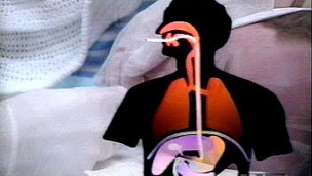 Watch a physician perform an endoscopy using coherent optic fibres to examine a patient's interior