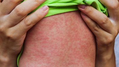 Measles